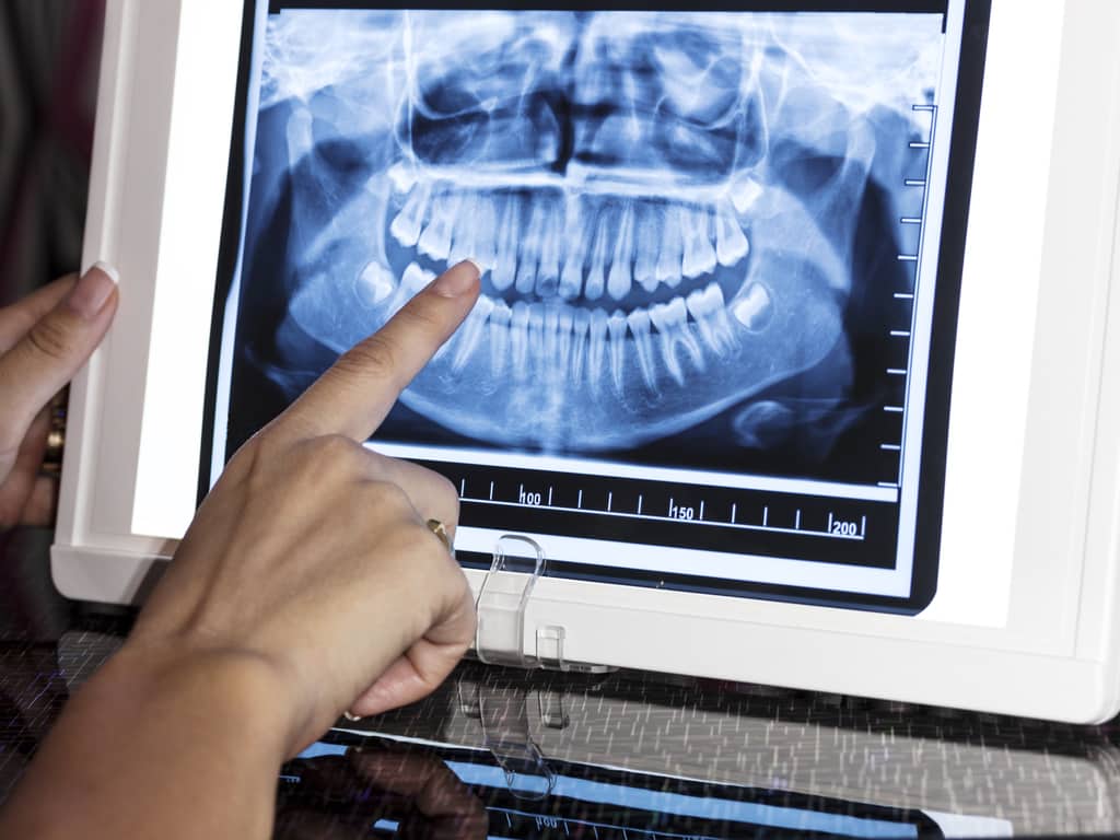 Prothèse complète sur implants - Dentiste - Centre dentaire Les Lilas